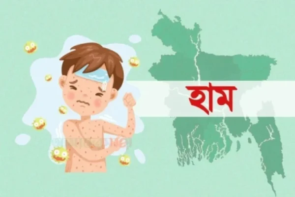 হাম উপসর্গে আরও ৩ জনের মৃত্যু